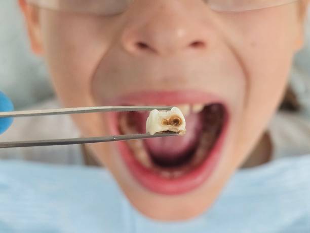 Best Dentist for Tooth Abscess  in Adrian, MO
